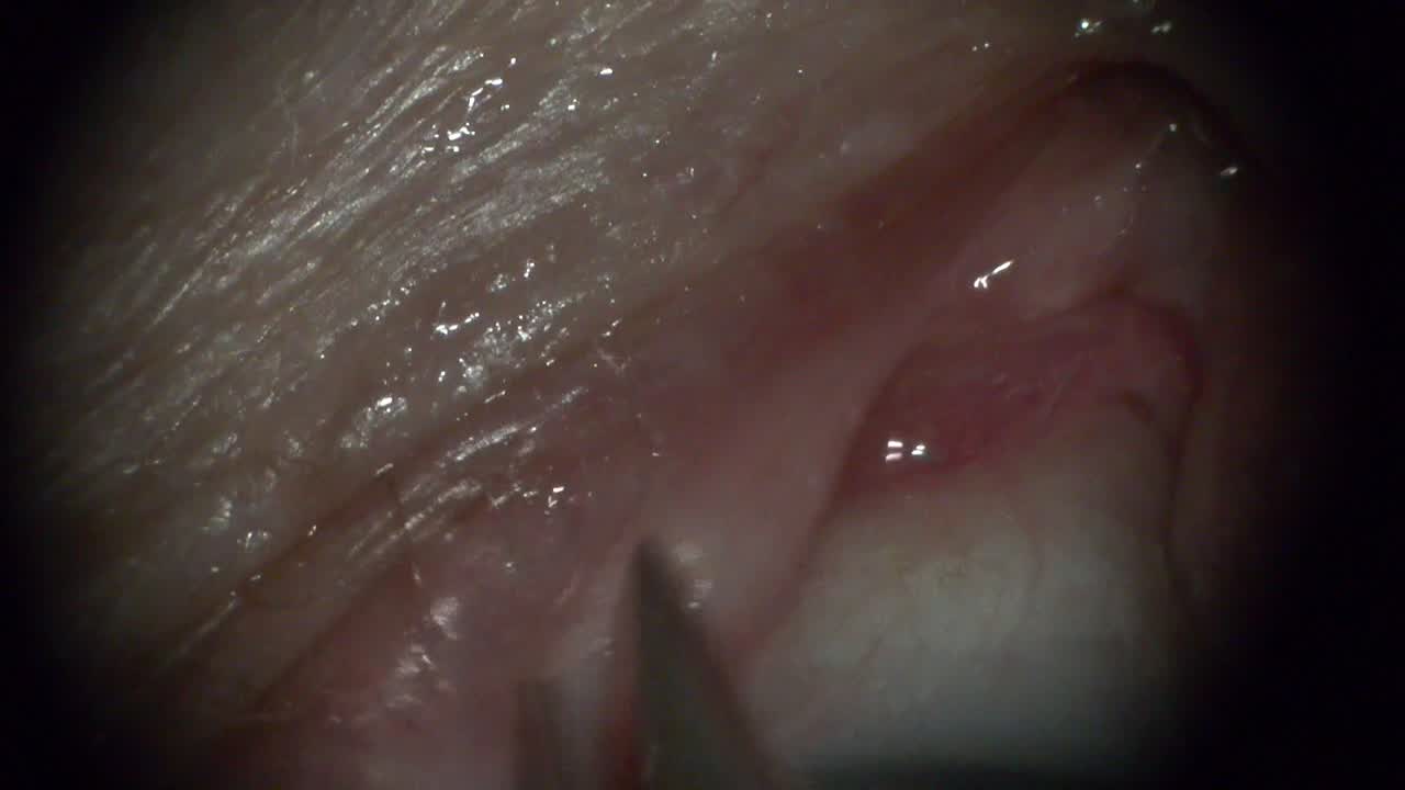 Dextenza Insertion Technique