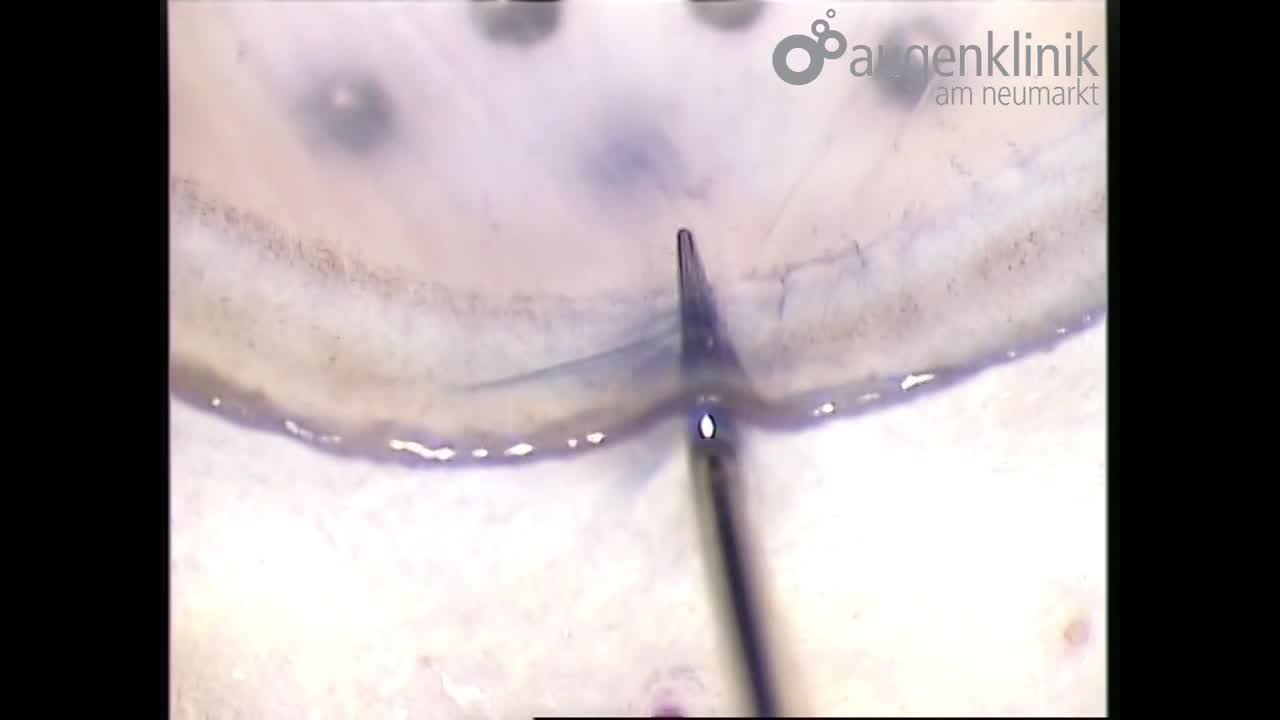 Transplant Preparation in DMEK