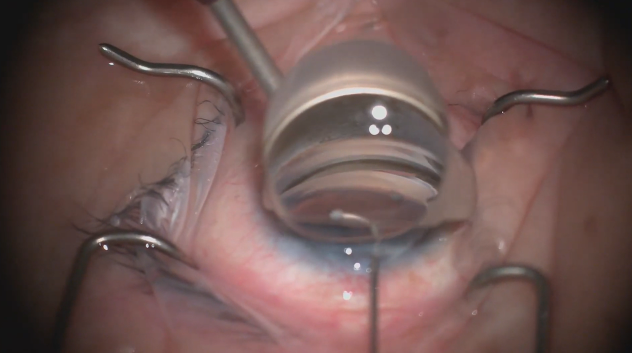 Omni Viscodilation and GATT Instructional Video
