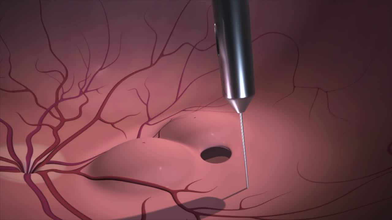 The Hydraulic Centripetal Macular Displacement Technique in the Treatment of Traumatic Full-Thickness Macular Holes