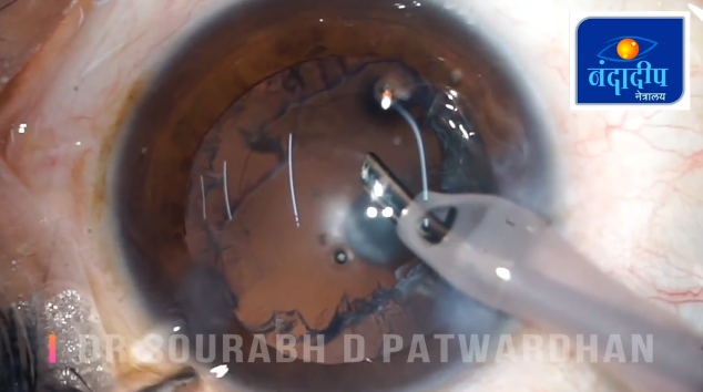 Sideways Sculpting Technique for Posterior Polar Cataract With Nuclear Sclerosis