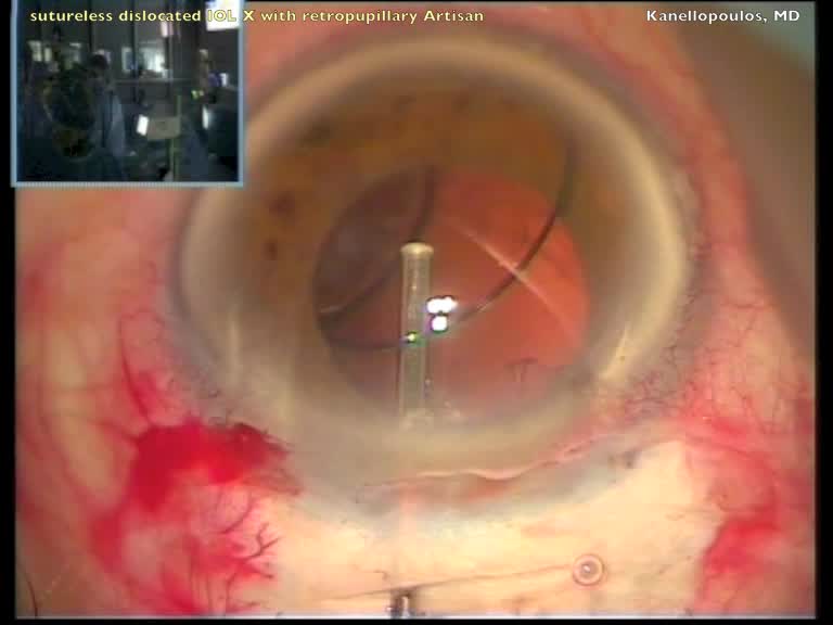 Sutureless IOL Exchange With Retropupillary Artisan Aphakia Lens