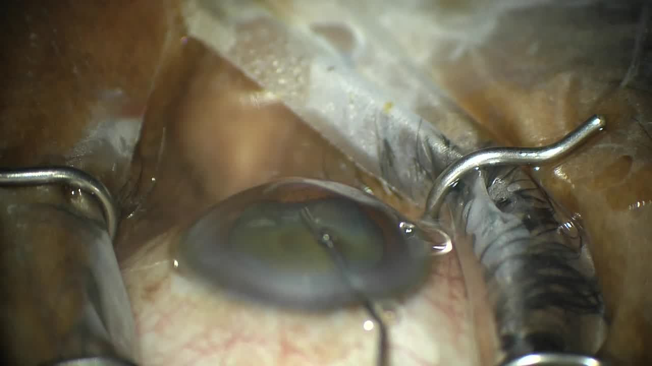 Targeted Placement of iStent Trabecular Micro-Bypass Stent (Glaukos)