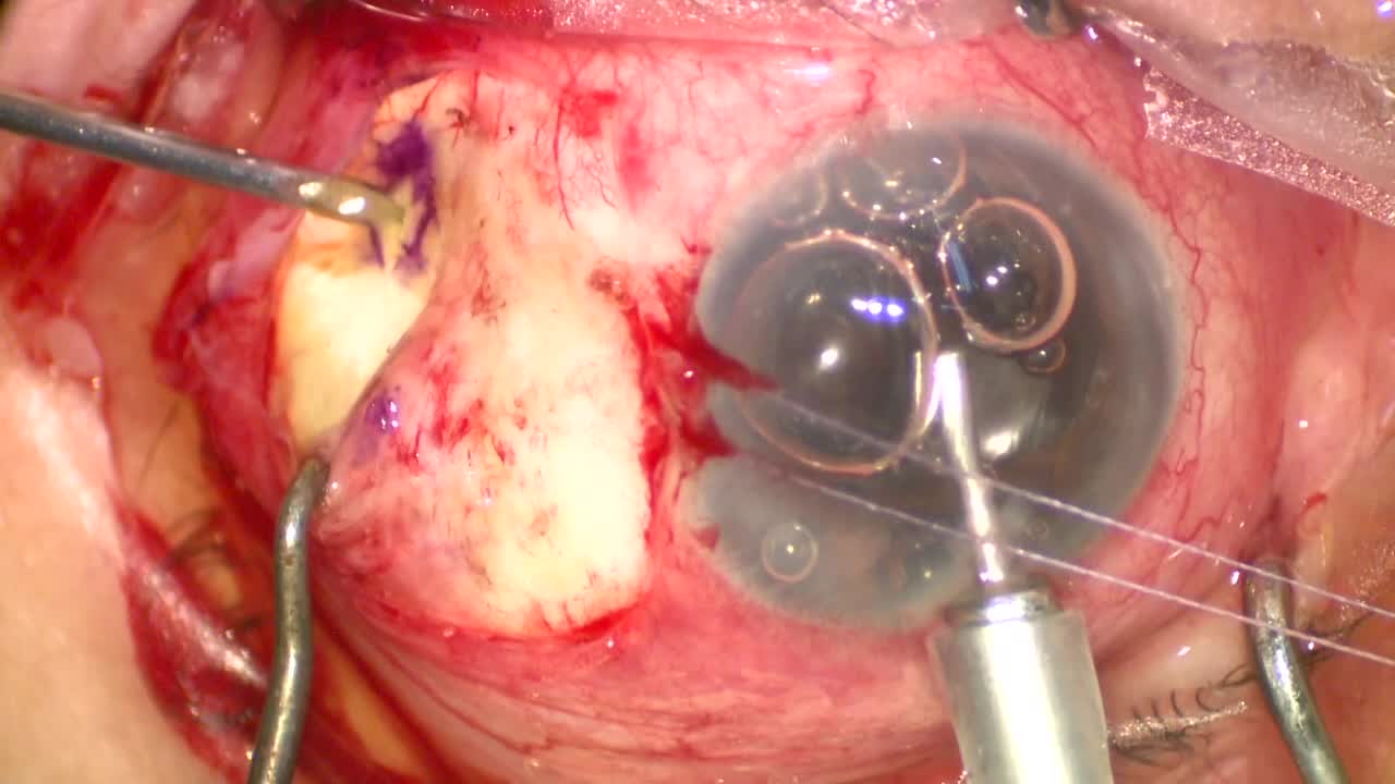 Choroidal Drainage Technique
