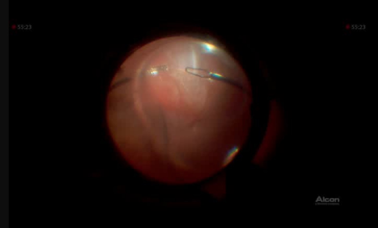 Vitrectomy Repair of Schisis-RD with PVR using Bi-manual Forceps