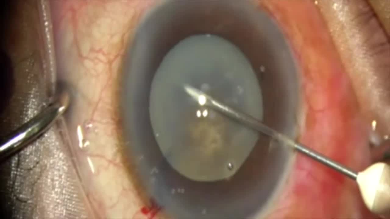 Role of Anterior Segment OCT to Prevent Argentinian Flag Sign