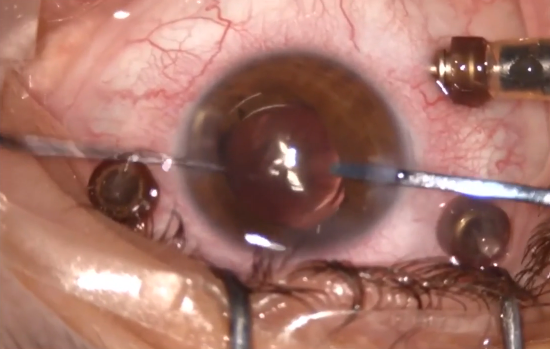 Diagonal Haptics Capture of Anterior Rhexis in Compromised Posterior Capsule