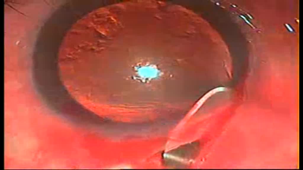 Corneal Staining in Manual Small Incision Cataract Surgery (MSICS)