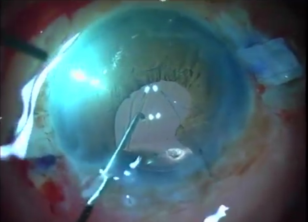 Glued IOL with Single Pass 4 Throw Pupilloplasty