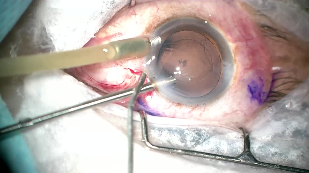Capsular Rupture and ECP