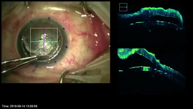 Intraoperative OCT in Grip and Rip ALK
