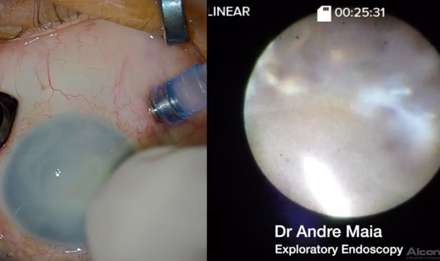 Exploratory Endoscopy