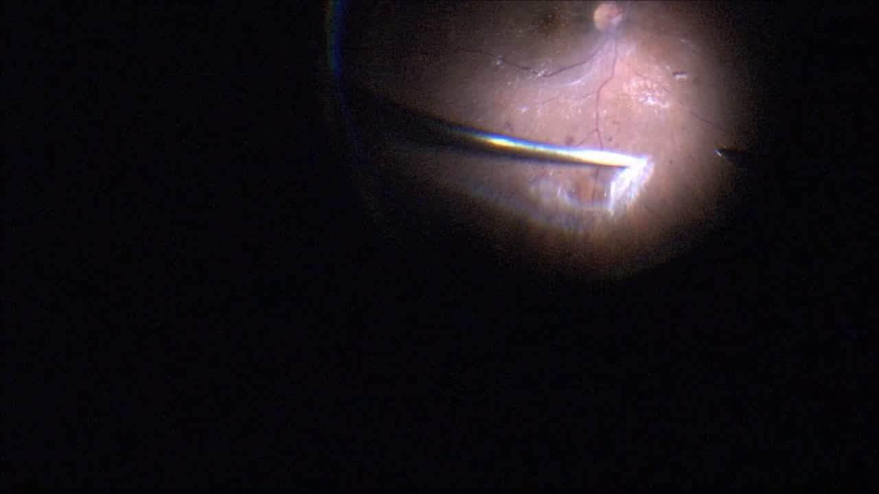 Full Thickness Macular Hole in the Setting of DR and Asteroid Hyalosis