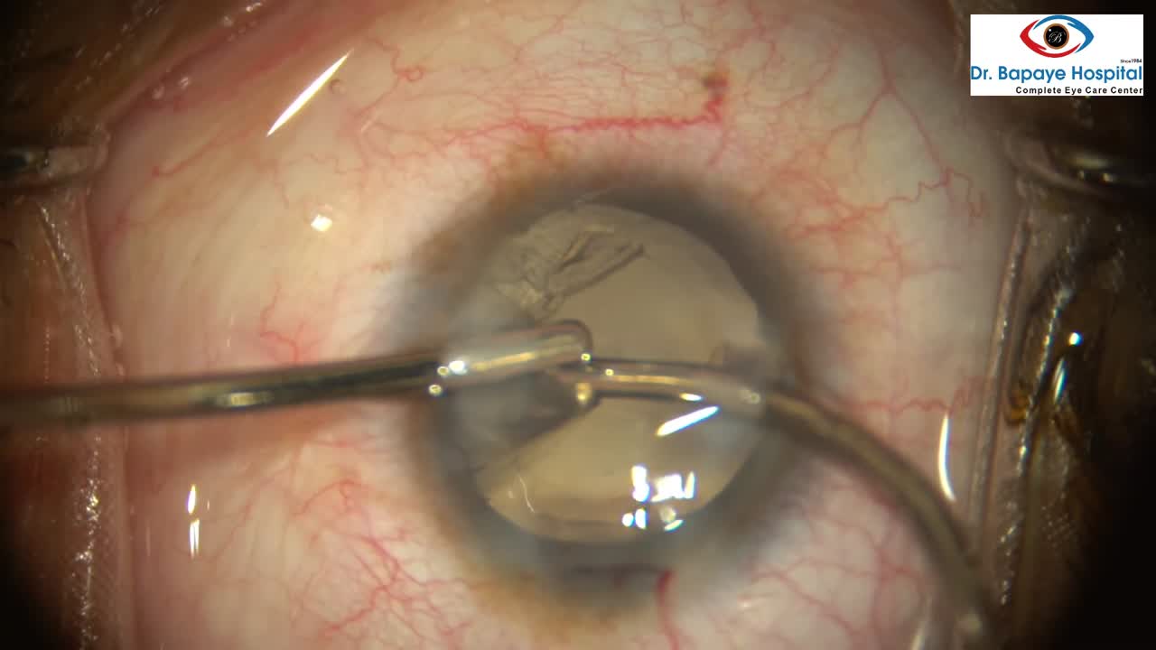 Phacoemulsification in Relative Anterior Microphthalmos