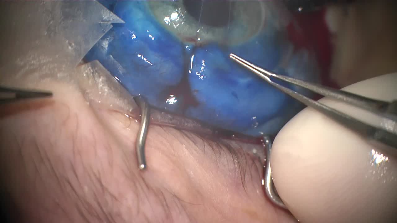Complex Cataract Extraction With Transconjunctival Bleb Compression Sutures