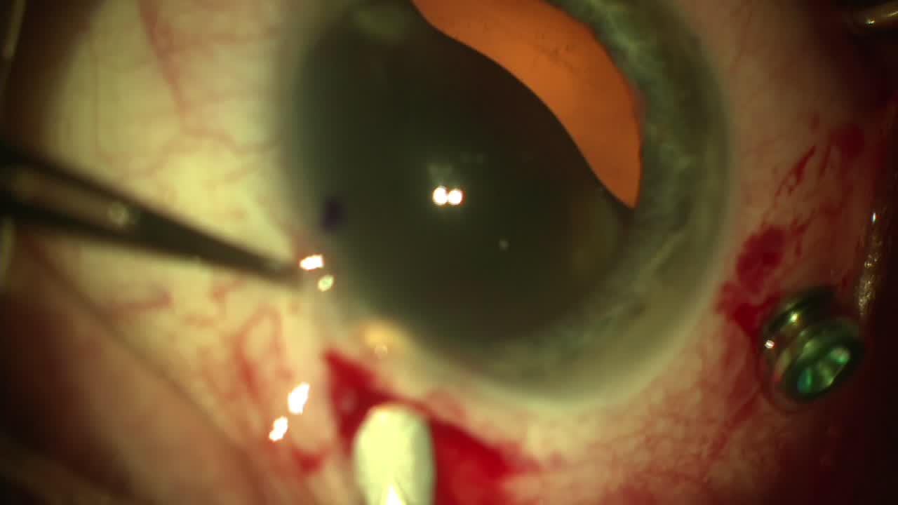 Black Cataract with miLoop