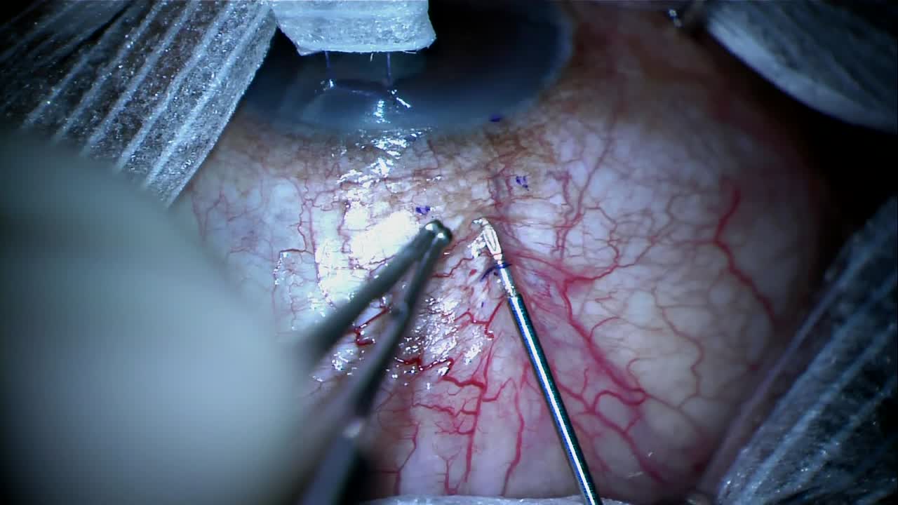 Xen Gel Stent Ab Externo Transconjunctival Technique: 1 Year Outcomes