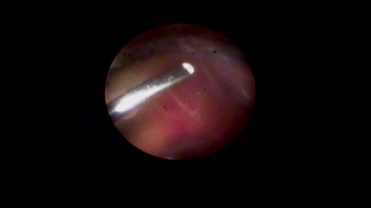 Endoscopic Membrane Peeling for PVR