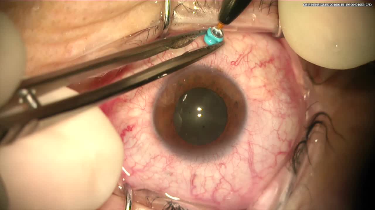 Thank God I'm a Retinal Surgeon 