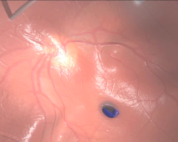 Large Macular Cyst with Full Thickness Macular Hole with Old Total Retinal Detachment