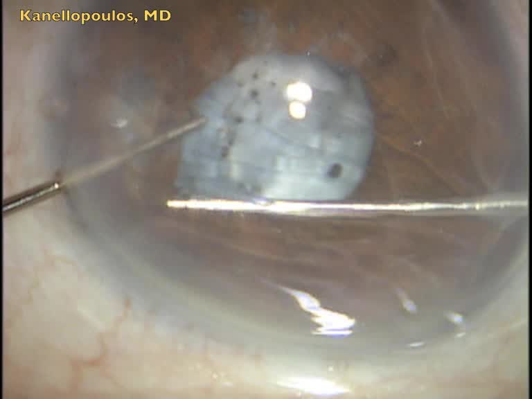Sutureless PPV Residual Cataract Extraction Behind Implanted IOL
