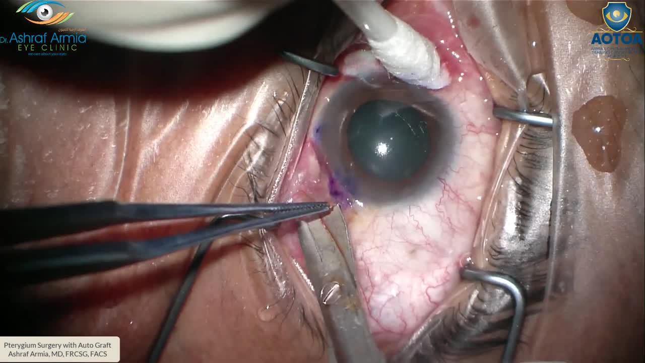 Pterygium Surgery With Conjunctival Autograft