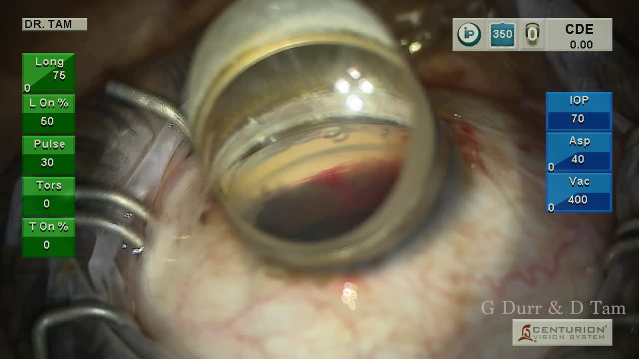 Ab Interno Viscodilation and Two Trabecular Microbypass Stents