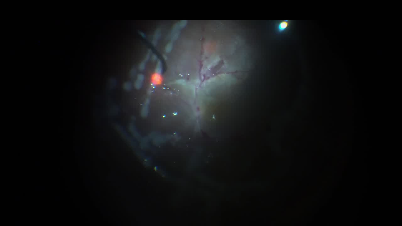 Fibrovascular Tissue Peel for Diabetic Retinopathy and Retinal Detachment