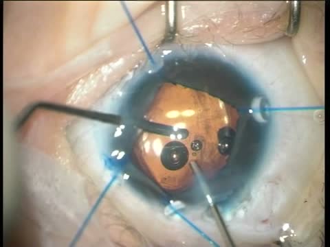 Bilateral Congenital Cataract Surgery in a 45-Day-Old Baby: Right Eye