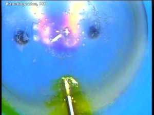 Refractive lenticule Extraction with CXL