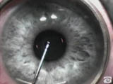 Conductive Keratoplasty