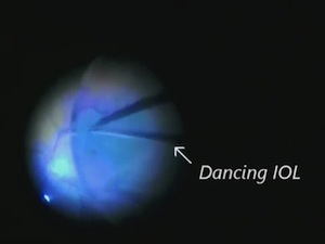 Macular Hole Surgery under a Dancing Intra-Ocular Lens IOL