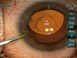 Recentering a one-piece IOL