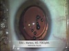 Implantation of the FineVision trifocal IOL