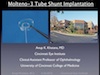 IOP Glaucoma - Tube Shunt 