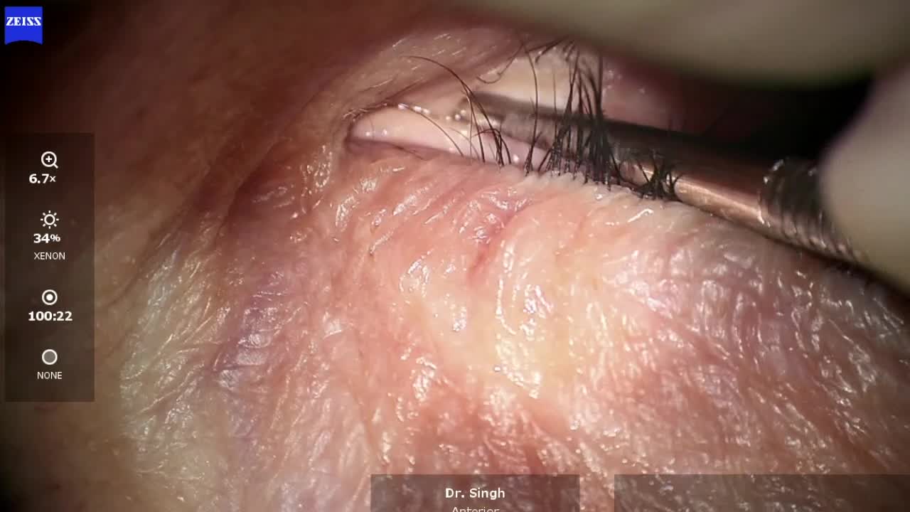 Importance of Eyelid Positioning for Dextenza