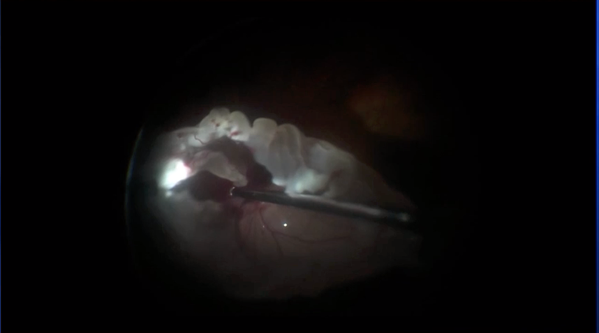 Perfluoron Injection