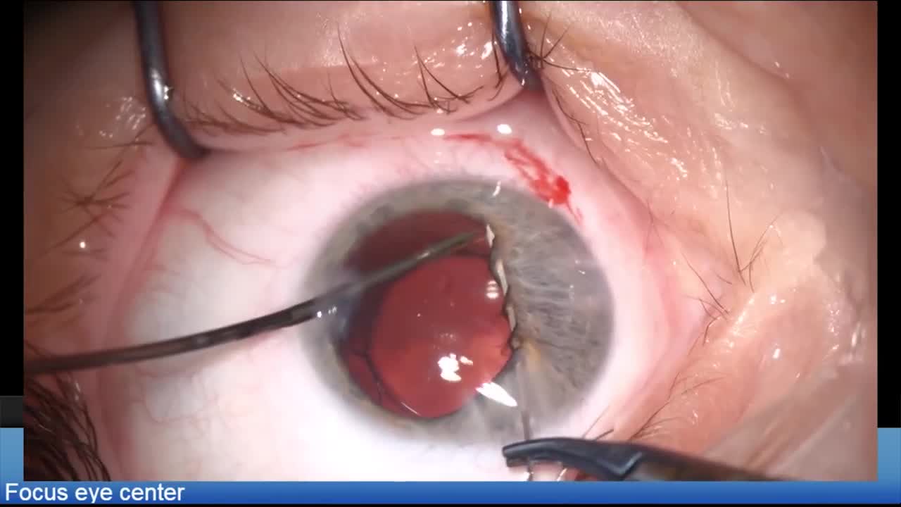 Traumatic Cataract and Mydriasis