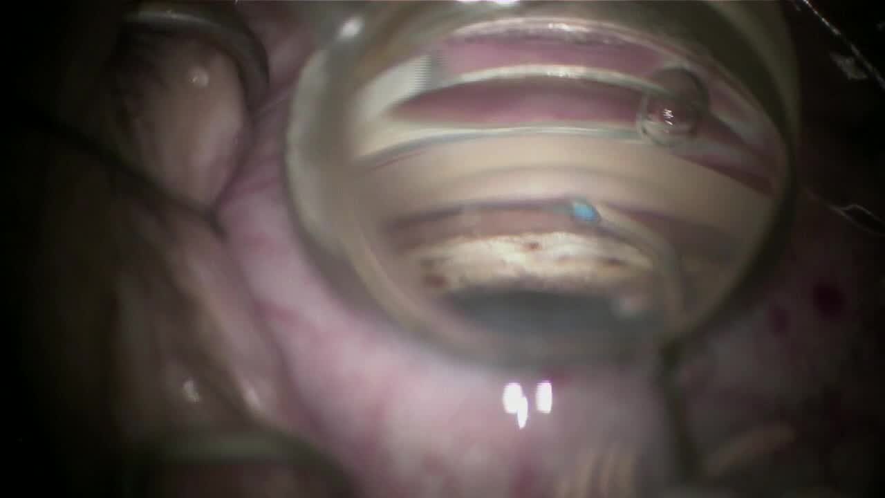 Combining Procedures to Maximize Conventional Outflow 