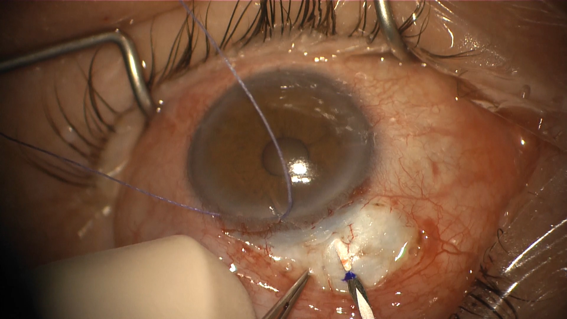 An Alternative Device for Patients With Moderate Glaucoma