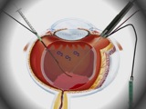 Pharmacosurgery with the Intrector