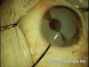 Removal of a Cosmetic Iris Prosthesis