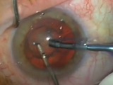 Phaco Without OVD