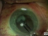 Cryoextraction to recover dropped nucleus