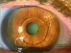 Complications of Phakic Lenses: Cataract