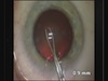 Capsulorhexis Forceps Cross-Action Revisited