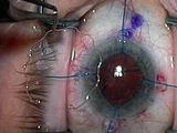 Zonular Dialysis 