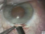 KPE with Insertion of Posterior Chamber Lens Impending Expulsive Hemorrhage