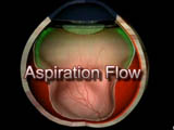 Vitrectomy - Aspiration Flow
