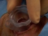 InVitria: Intravitreal Injection Assistant